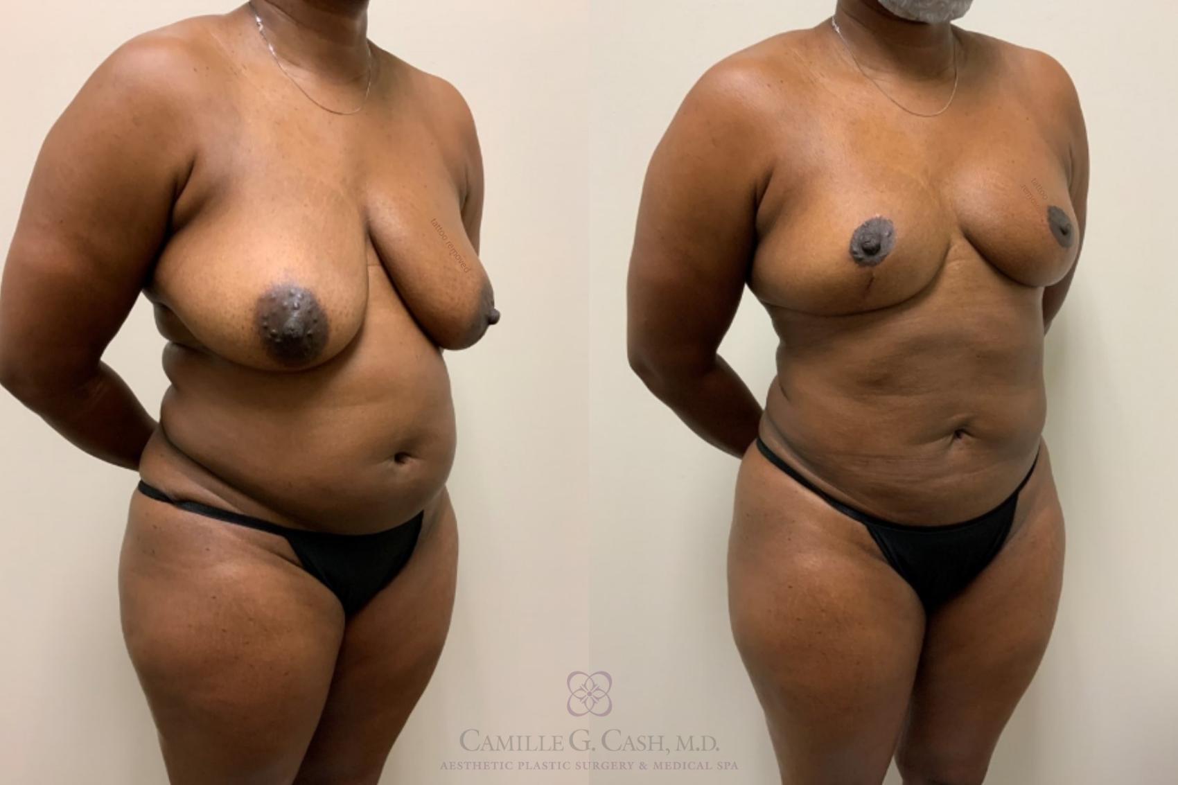 Before & After Mommy Makeover Case 550 Left Oblique View in Houston, TX