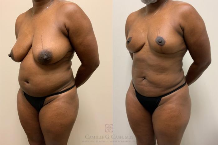 Before & After Mommy Makeover Case 550 Right Oblique View in Houston, TX