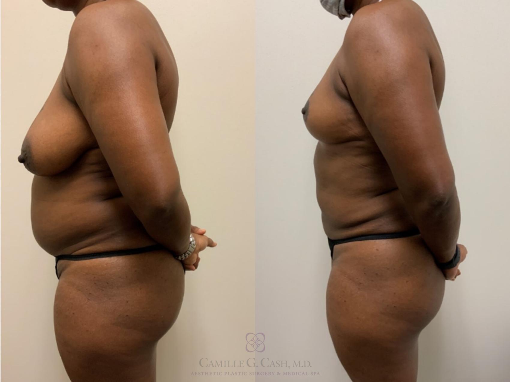 Before & After Mommy Makeover Case 550 Right Side View in Houston, TX