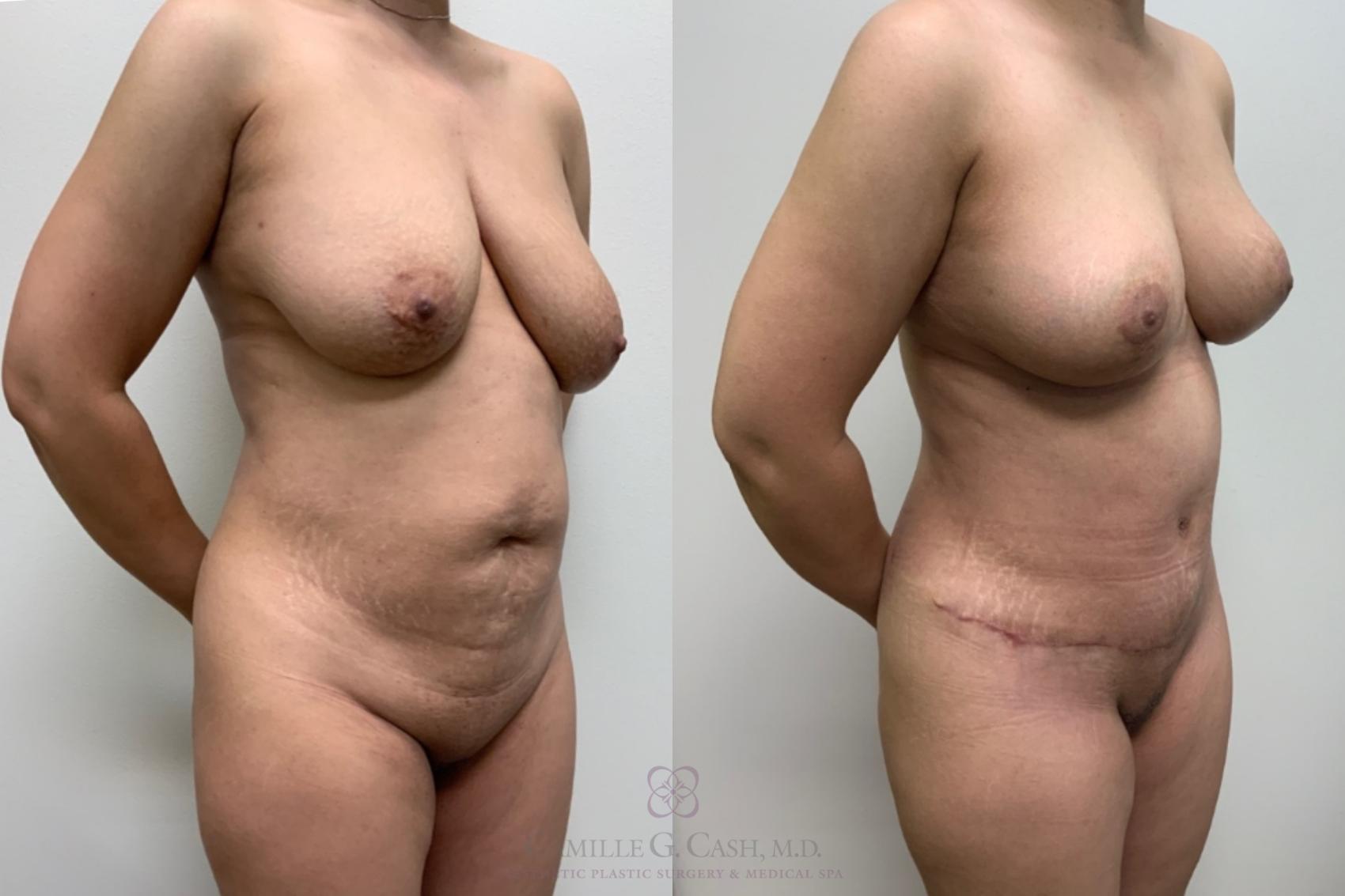 Before & After Mommy Makeover Case 594 Left Oblique View in Houston, TX