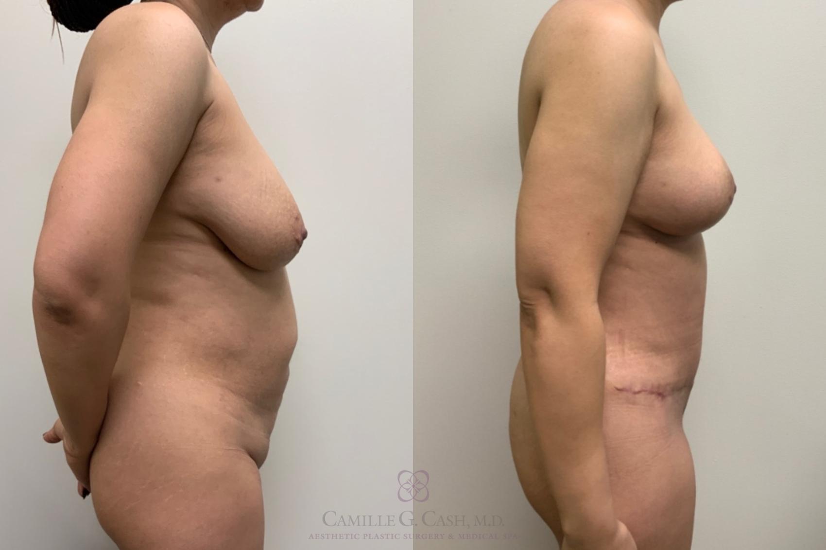 Before & After Mommy Makeover Case 594 Left Side View in Houston, TX