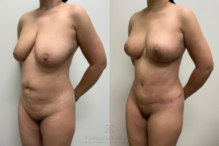Before & After Mommy Makeover Case 594 Right Oblique View in Houston, TX