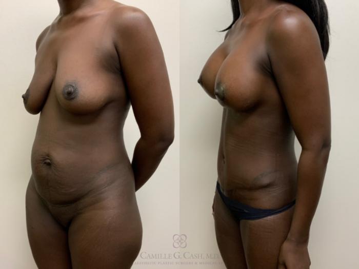 Before & After Mommy Makeover Case 621 Right Oblique View in Houston, TX