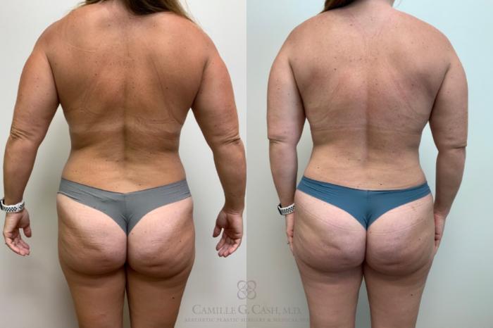 Before & After Mommy Makeover Case 625 Back View in Houston, TX