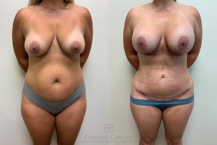 Before & After Mommy Makeover Case 625 front 2 View in Houston, TX