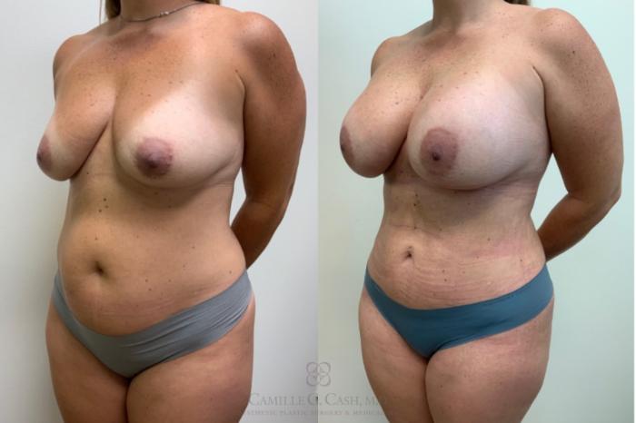 Before & After Mommy Makeover Case 625 Left Oblique View in Houston, TX