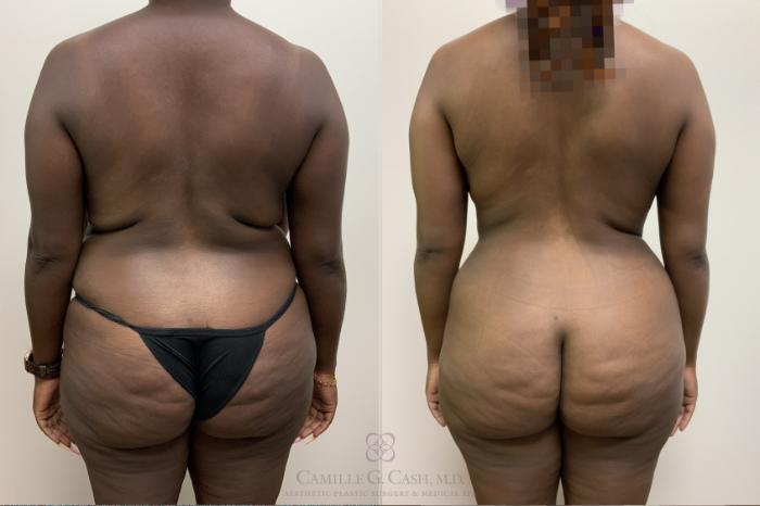 Before & After Mommy Makeover Case 652 Back View in Houston, TX