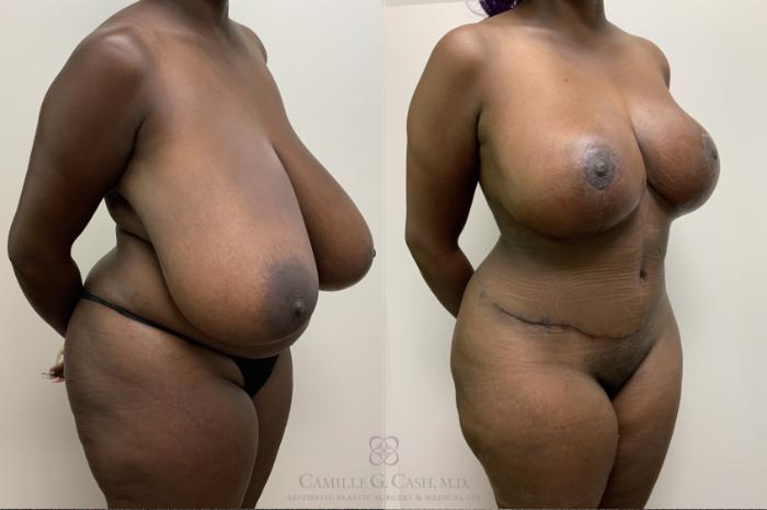 Before & After Mommy Makeover Case 652 Right Oblique View in Houston, TX