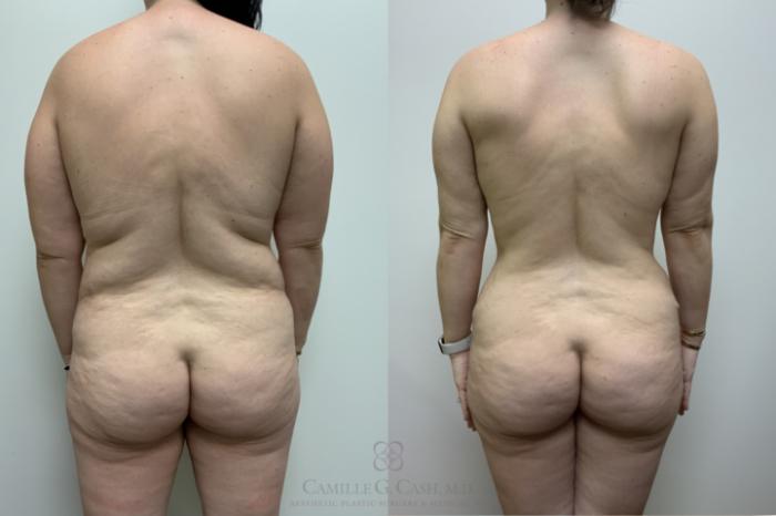 Before & After Mommy Makeover Case 660 Back arms down View in Houston, TX