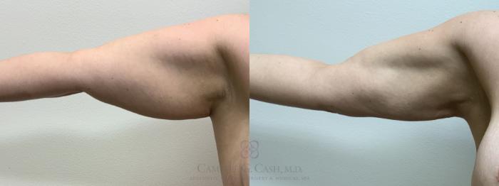 Before & After Mommy Makeover Case 660 left arm View in Houston, TX