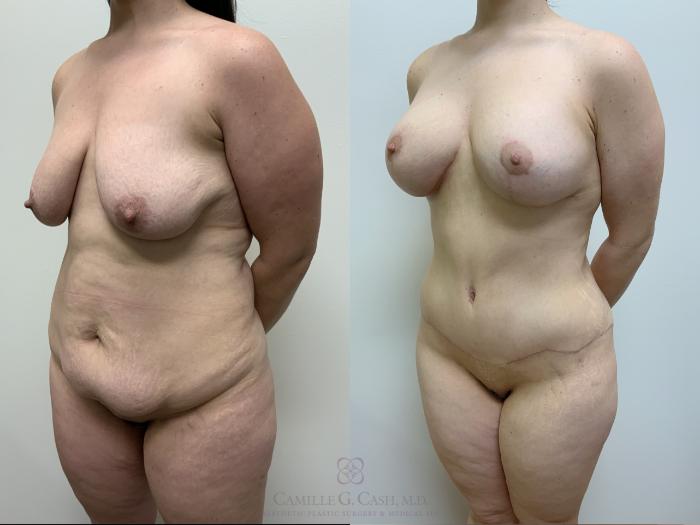 Before & After Mommy Makeover Case 660 Left Oblique View in Houston, TX