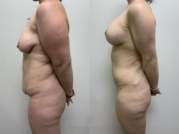 Before & After Mommy Makeover Case 660 Left Side View in Houston, TX