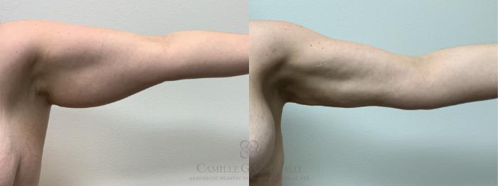 Before & After Mommy Makeover Case 660 right arm View in Houston, TX