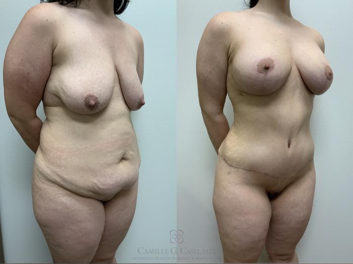 Before & After Mommy Makeover Case 660 Right Oblique View in Houston, TX