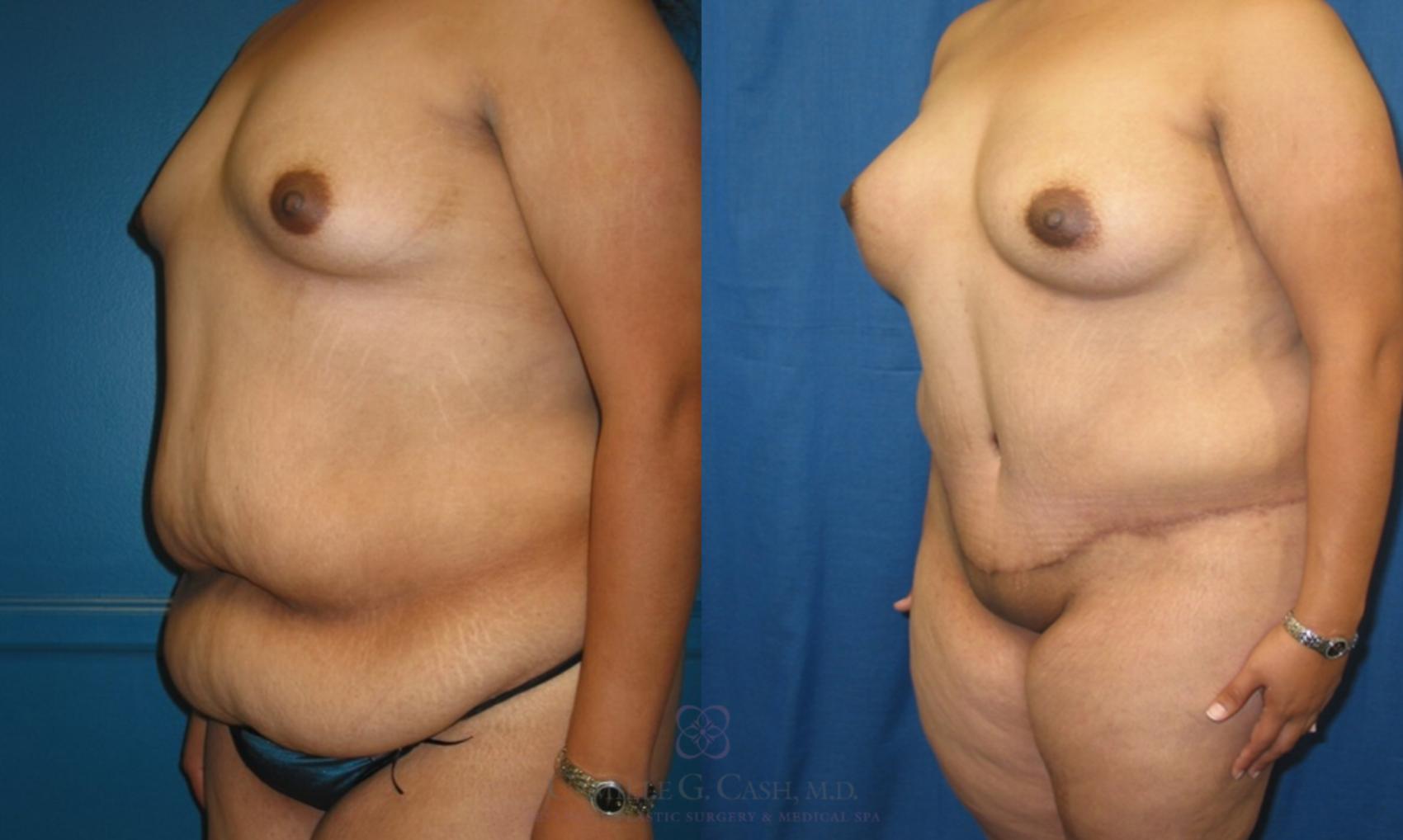 Before & After Mommy Makeover Case 68 View #2 View in Houston, TX