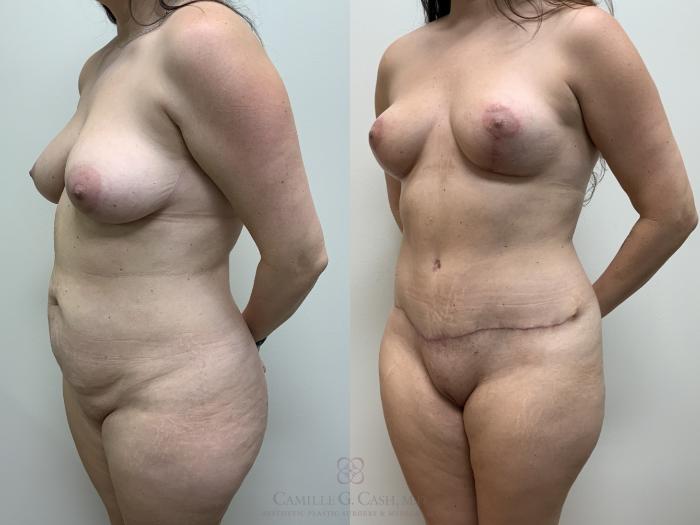 Before & After Mommy Makeover Case 682 Left Oblique View in Houston, TX