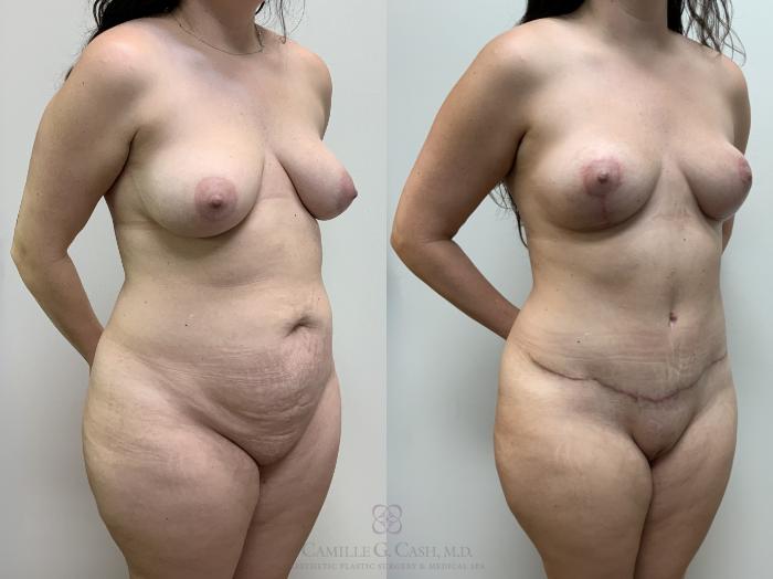 Before & After Mommy Makeover Case 682 r-ob- background View in Houston, TX