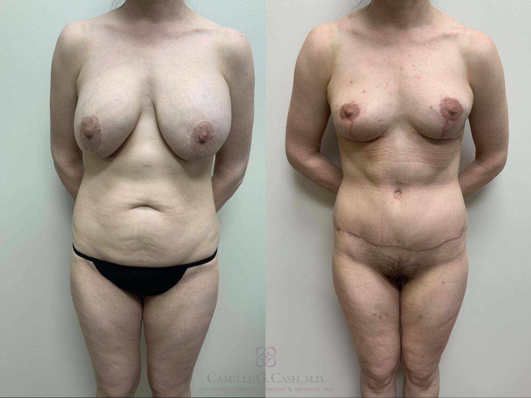 Before & After Mommy Makeover Case 688 front full 6 week View in Houston, TX