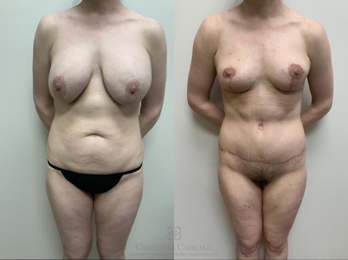 Before & After Mommy Makeover Case 688 front full 6 week View in Houston, TX