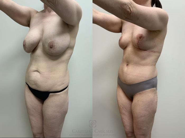 Before & After Mommy Makeover Case 688 Left Oblique View in Houston, TX