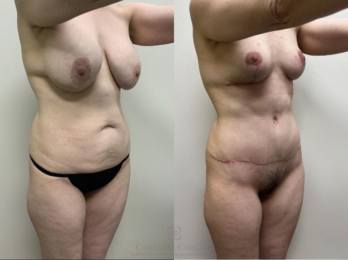 Before & After Mommy Makeover Case 688 Right Oblique View in Houston, TX