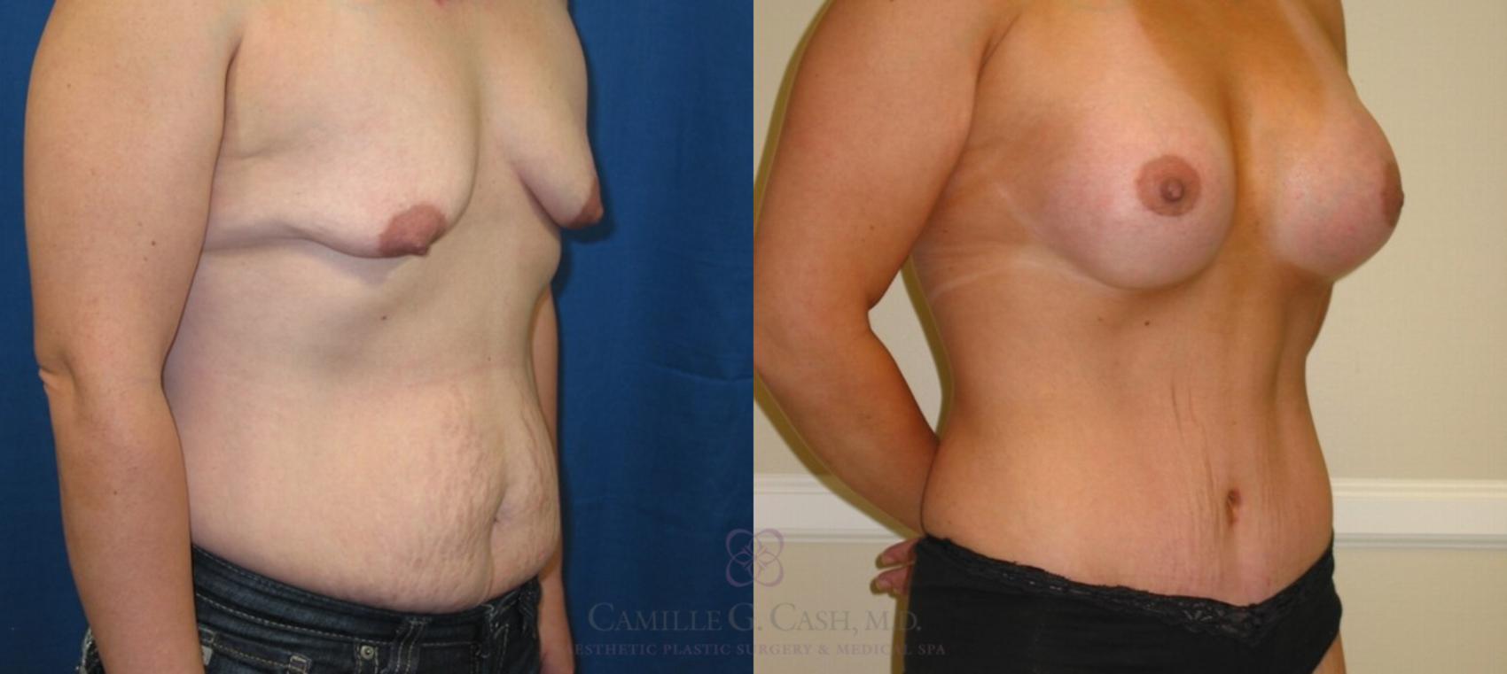 Before & After Mommy Makeover Case 69 View #4 View in Houston, TX