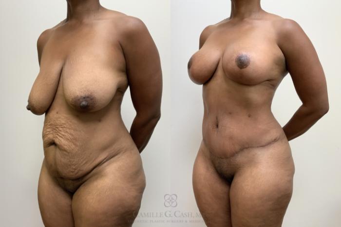 Before & After Mommy Makeover Case 696 Left Oblique View in Houston, TX