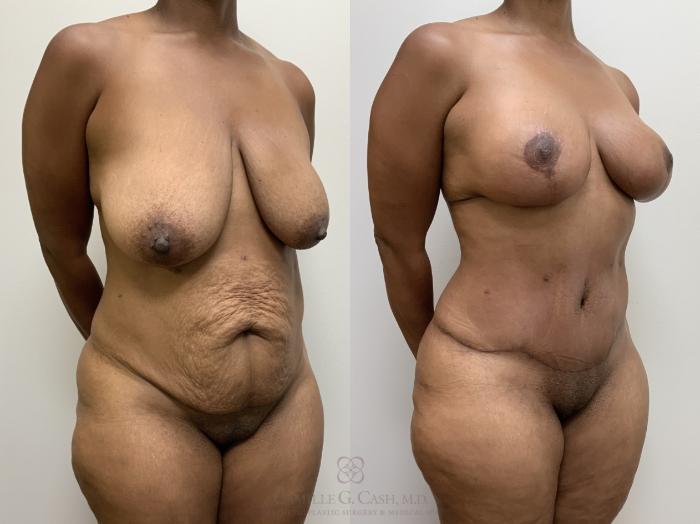 Before & After Mommy Makeover Case 696 Right Oblique View in Houston, TX