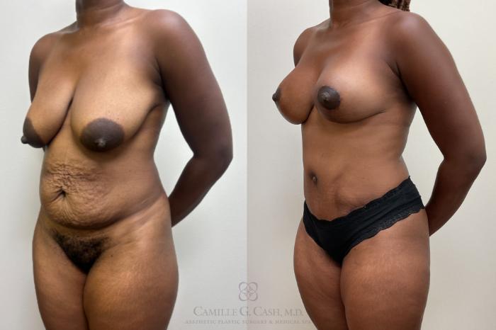 Before & After Mommy Makeover Case 710 Left Oblique View in Houston, TX