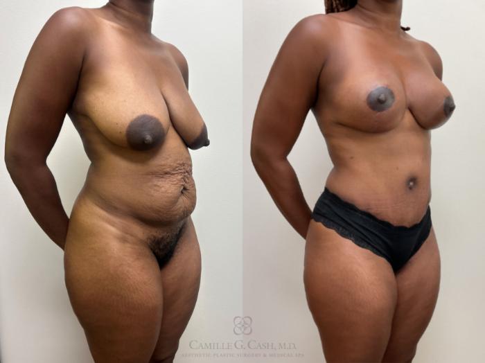 Before & After Mommy Makeover Case 710 Right Oblique View in Houston, TX