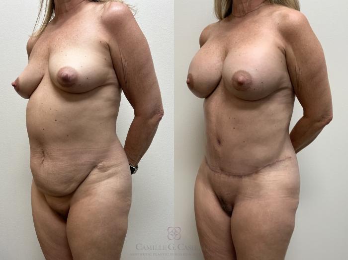 Before & After Mommy Makeover Case 711 Left Oblique View in Houston, TX