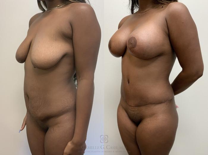 Before & After Mommy Makeover Case 716 Left Oblique View in Houston, TX