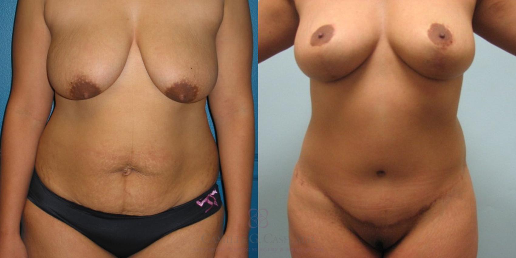 Before & After Mommy Makeover Case 93 View #1 View in Houston, TX