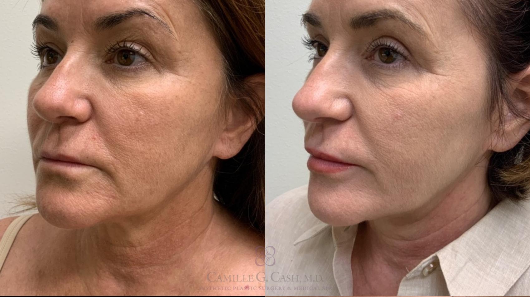 Before & After Morpheus8 Case 491 Right Oblique View in Houston, TX