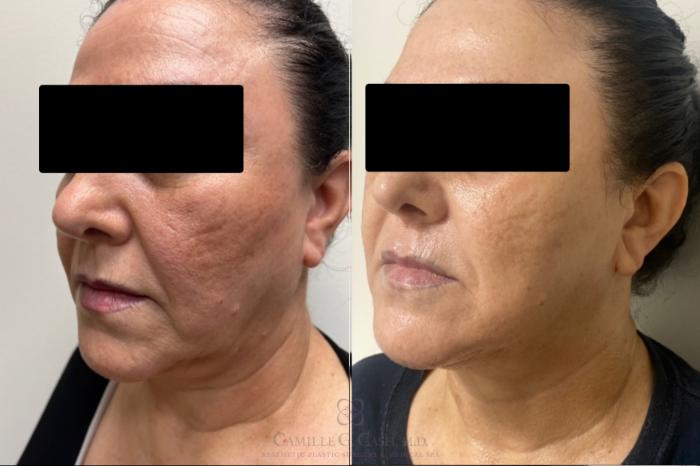 Before & After Morpheus8 Case 541 Right Oblique View in Houston, TX