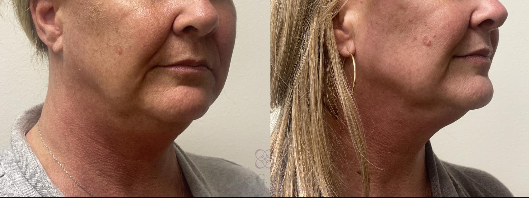 Before & After Morpheus8 Case 592 Left Oblique View in Houston, TX