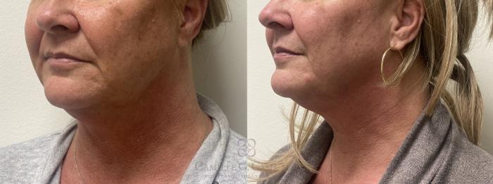 Before & After Morpheus8 Case 592 Right Oblique View in Houston, TX