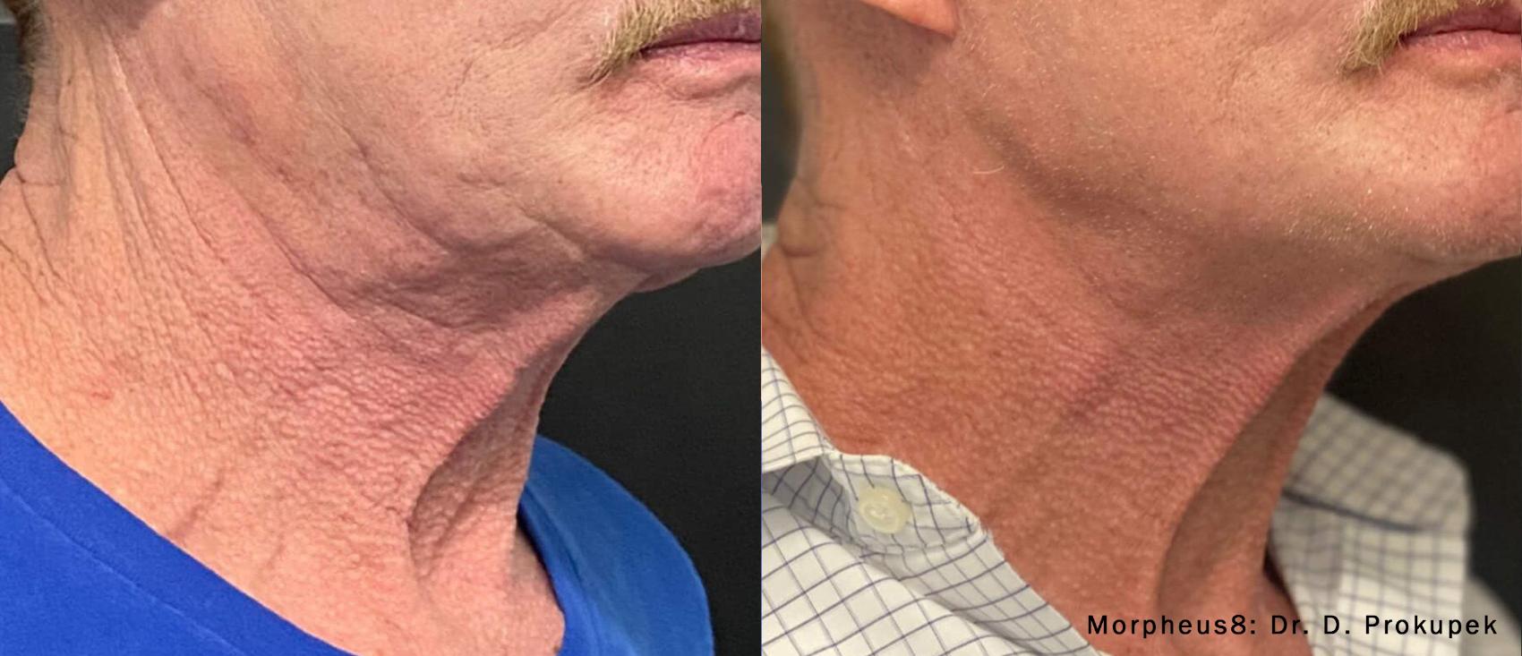 Before & After Morpheus8 Case 676 Right Oblique View in Houston, TX