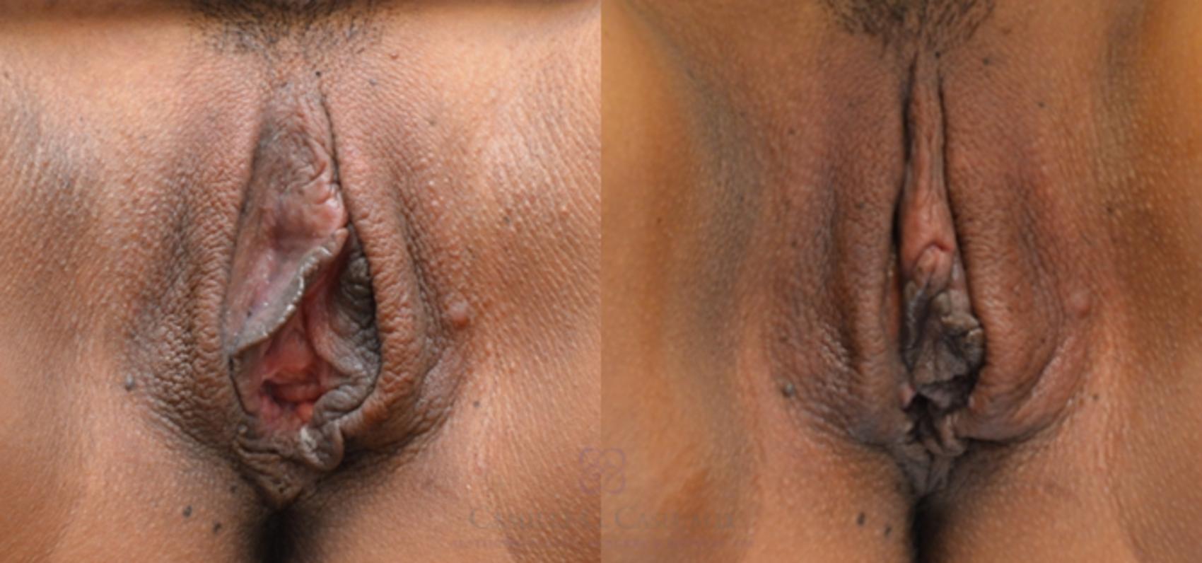 Before & After Non-Surgical Vaginal Rejuvenation Case 102 View #2 View in Houston, TX