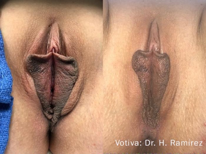Before & After Non-Surgical Vaginal Rejuvenation Case 499 Front View in Houston, TX