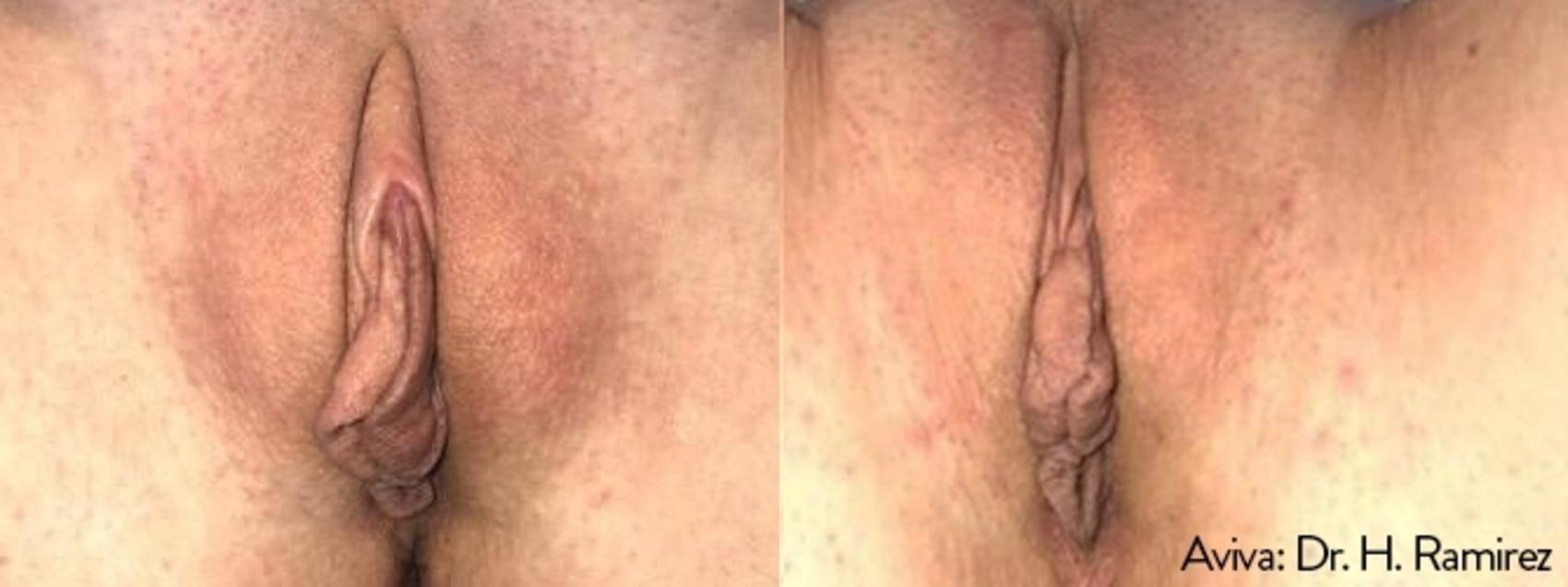 Before & After Non-Surgical Vaginal Rejuvenation Case 500 Front View in Houston, TX