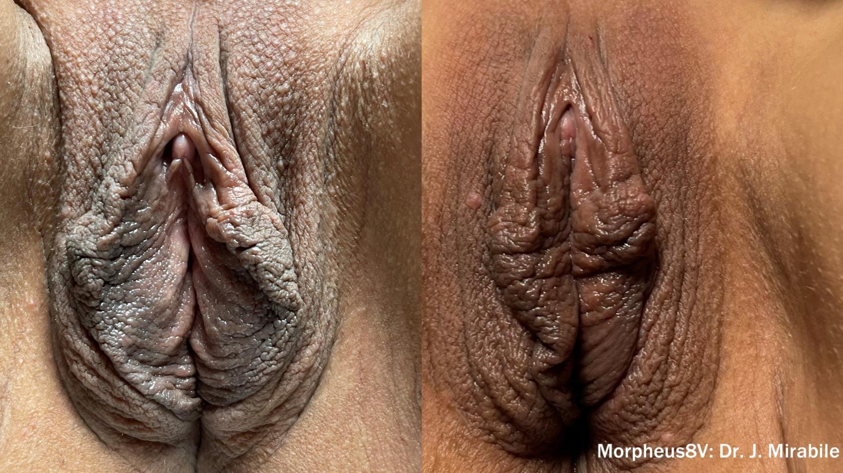 Before & After Non-Surgical Vaginal Rejuvenation Case 669 Front View in Houston, TX