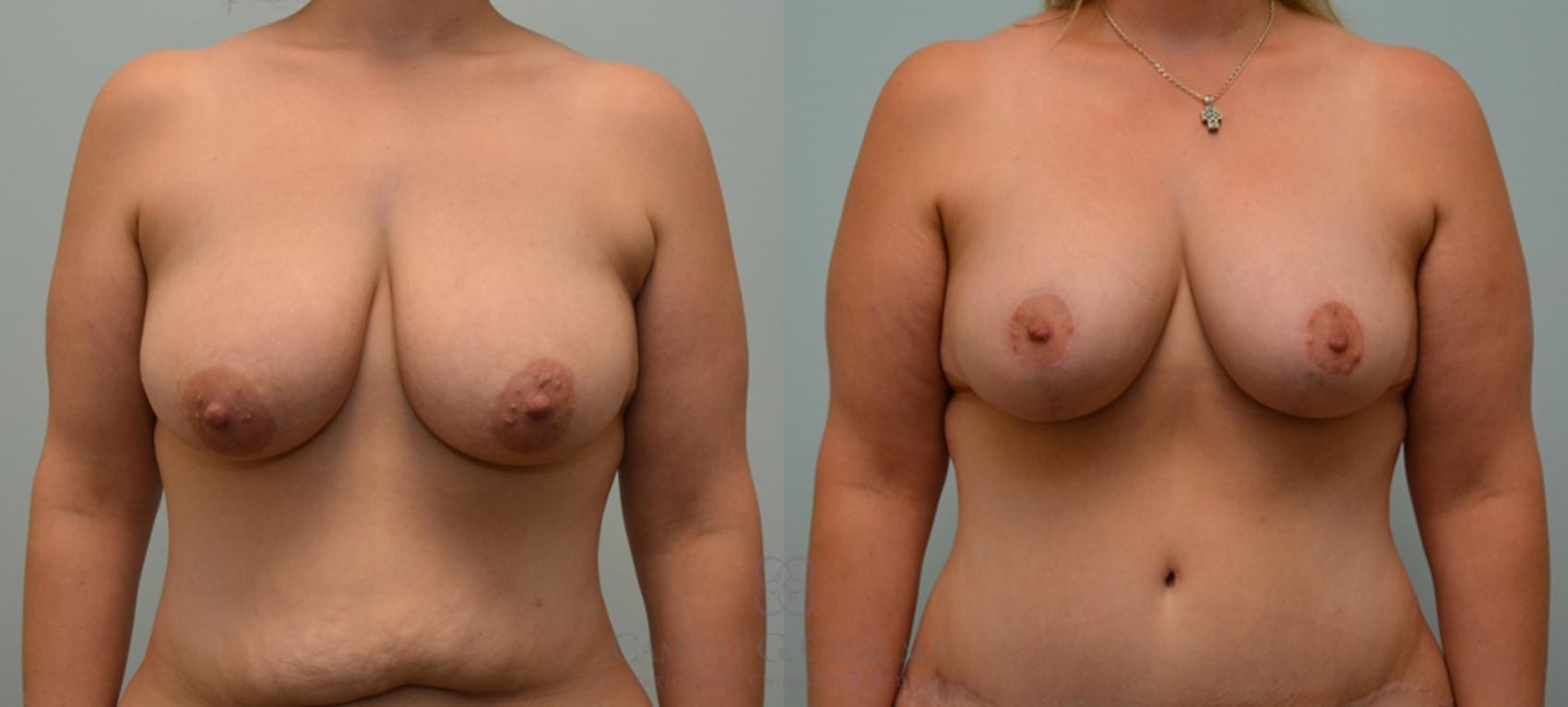 Before & After Breast Lift Case 125 View #1 View in Houston, TX
