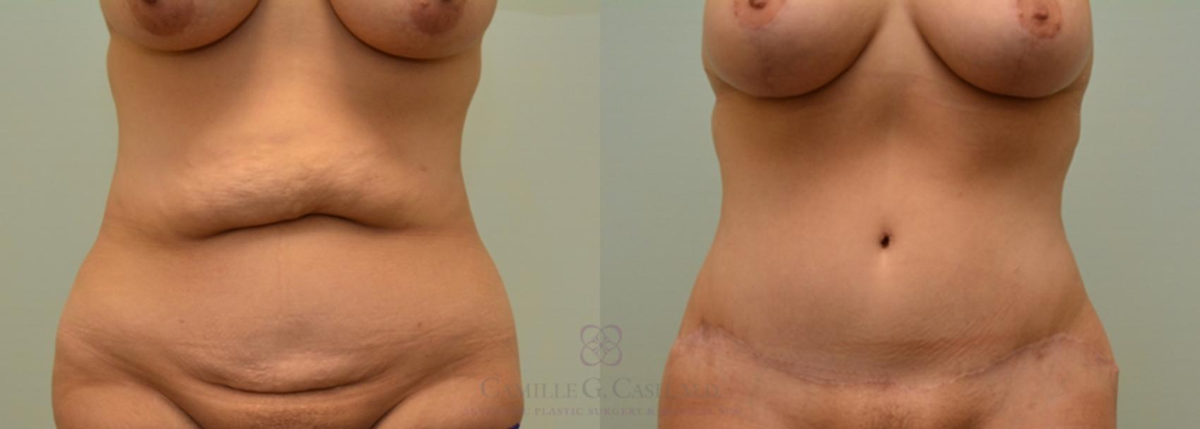 Before & After Body Lift Case 125 View #2 View in Houston, TX