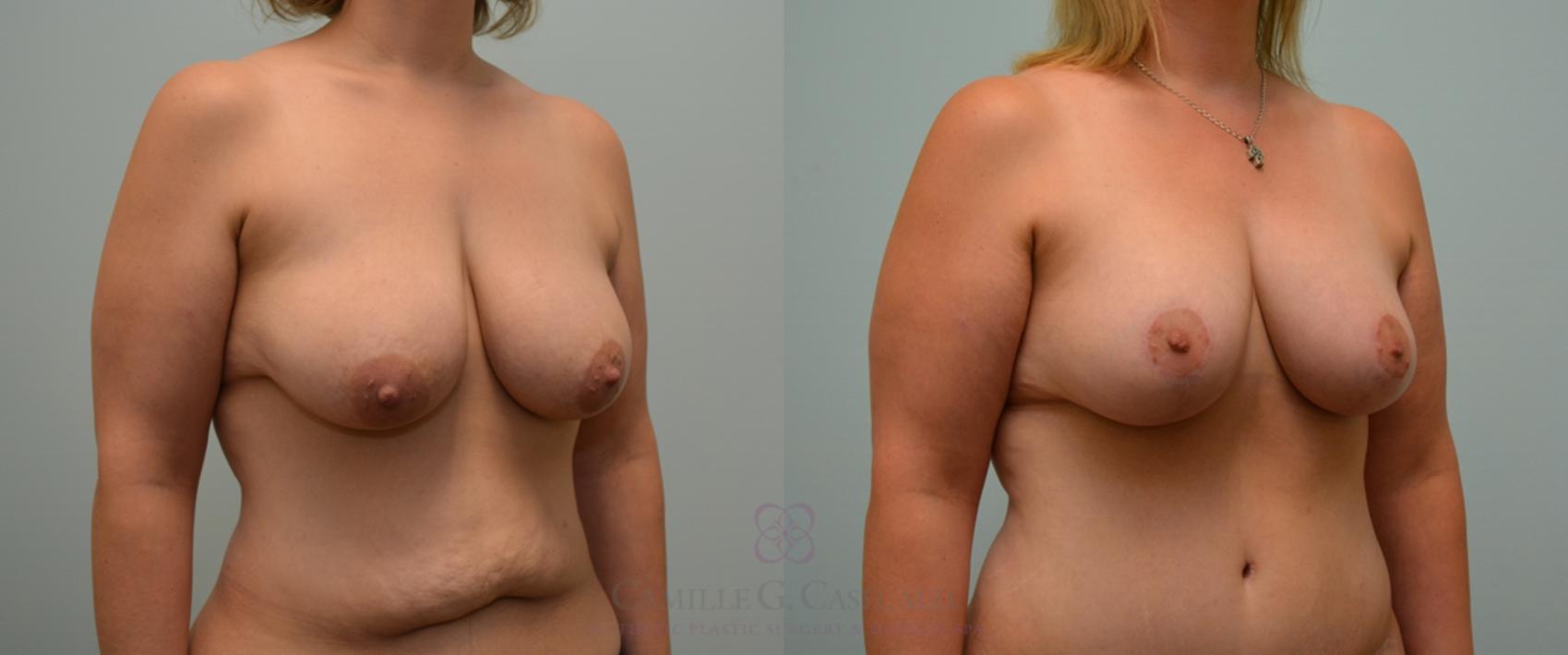 Before & After Post-Weight Loss Body Contouring Case 125 View #3 View in Houston, TX