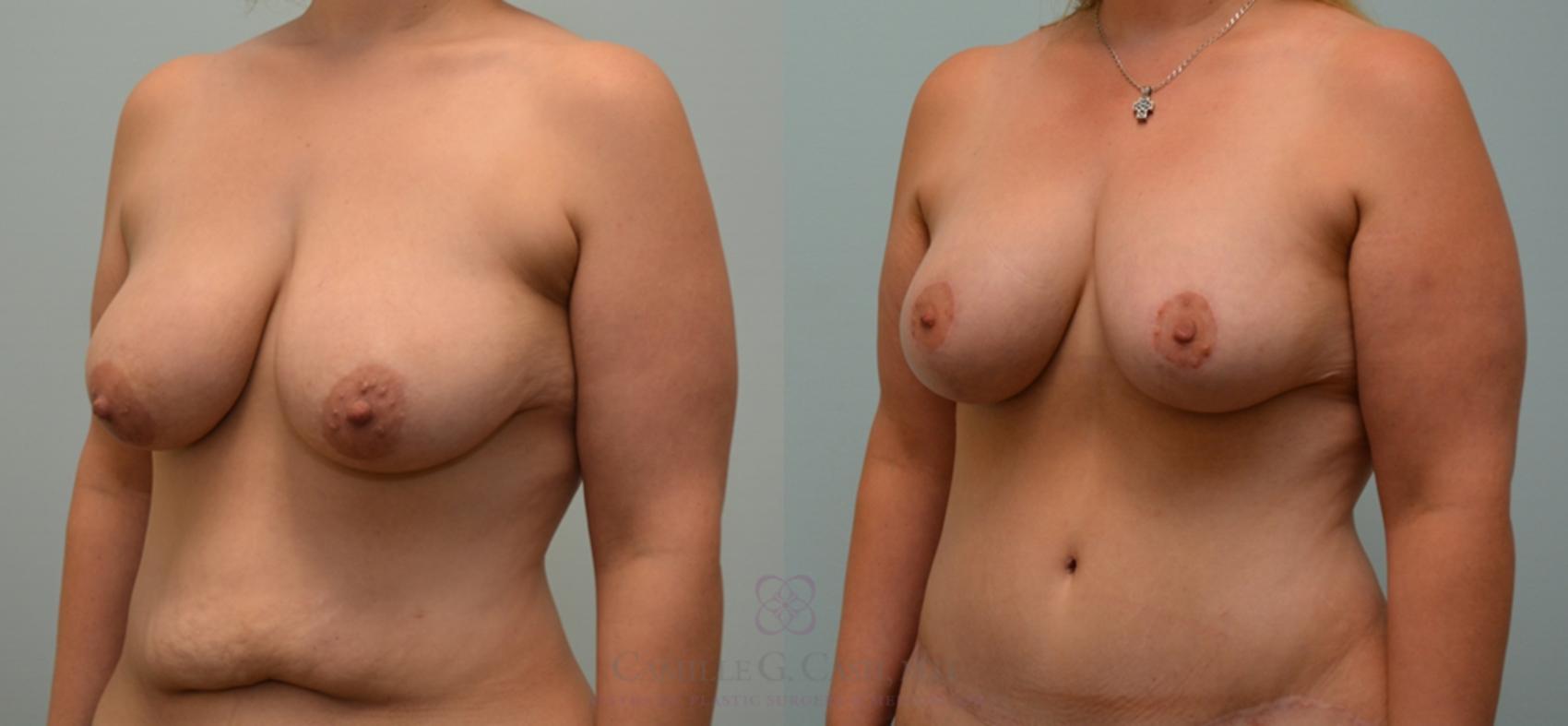 Before & After Body Lift Case 125 View #4 View in Houston, TX