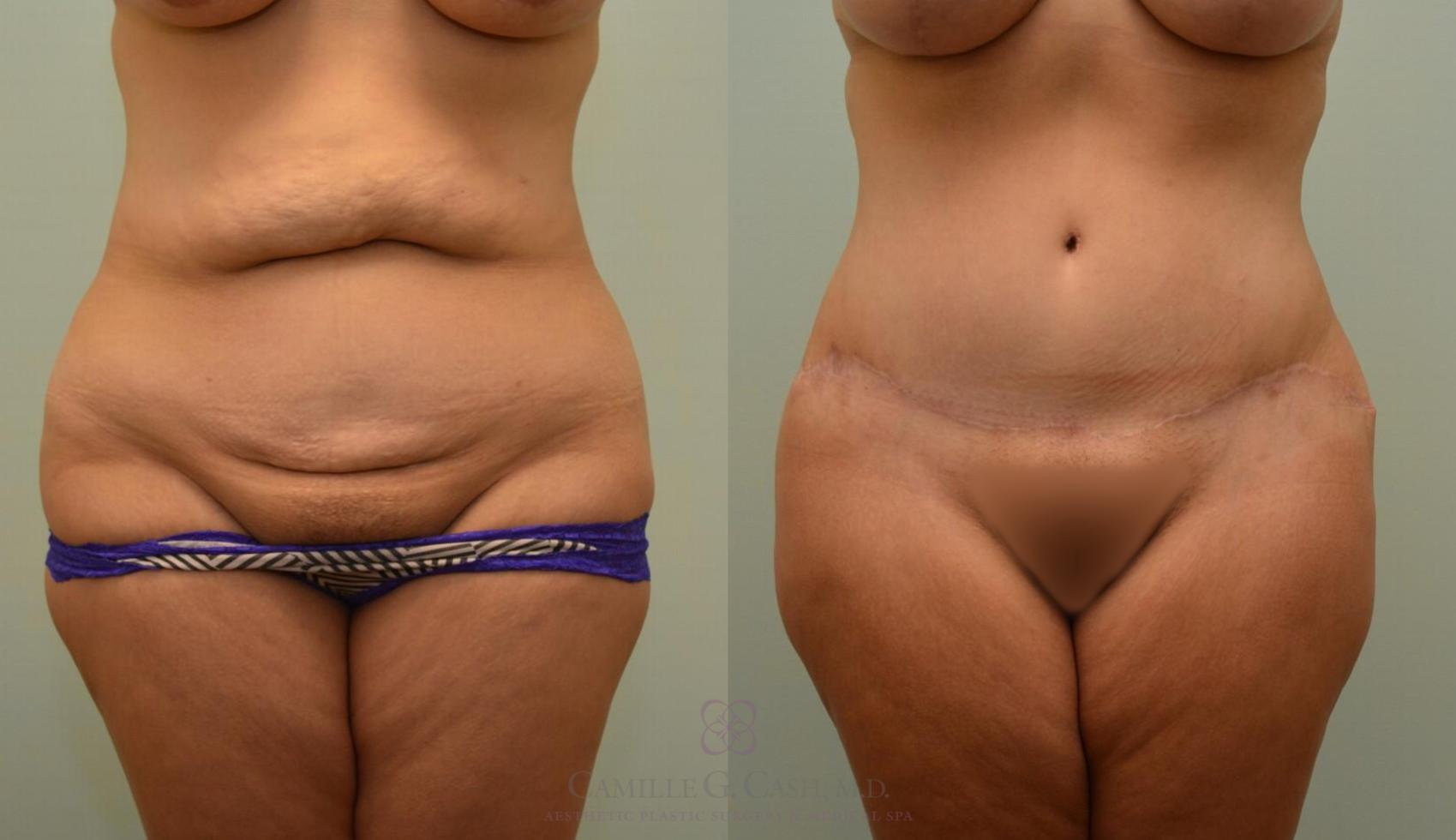Before & After Body Lift Case 125 View #6 View in Houston, TX