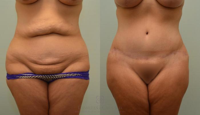 Before & After Breast Lift Case 125 View #6 View in Houston, TX