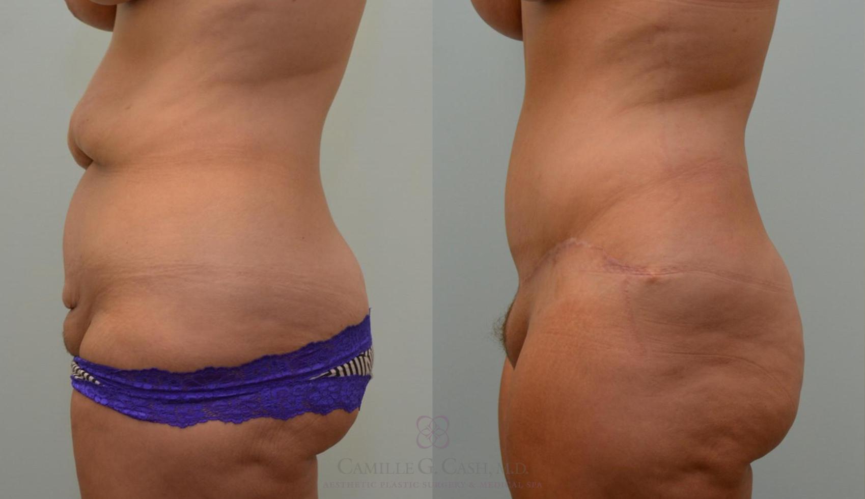Before & After Post-Weight Loss Body Contouring Case 125 View #7 View in Houston, TX
