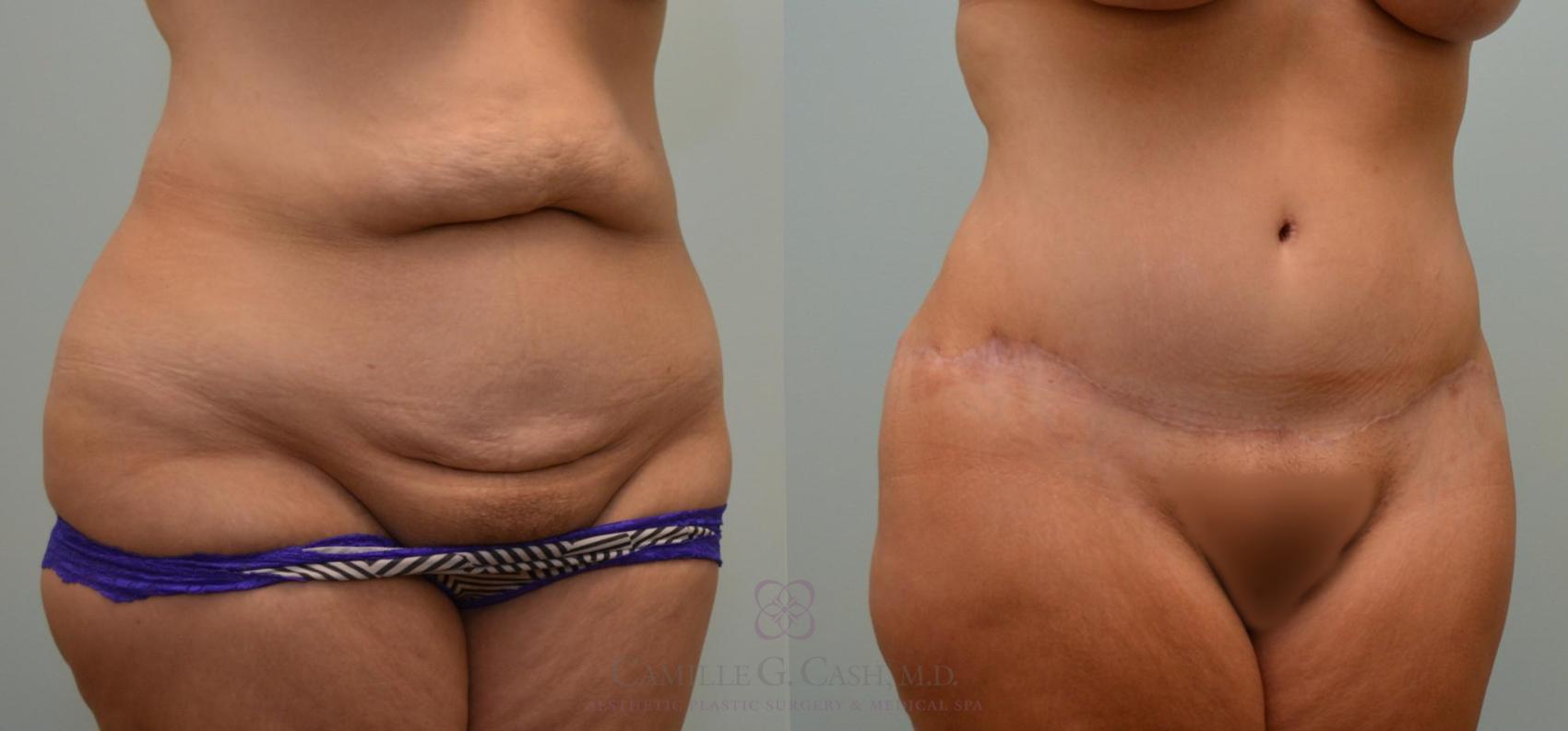 Before & After Post-Weight Loss Body Contouring Case 125 View #8 View in Houston, TX